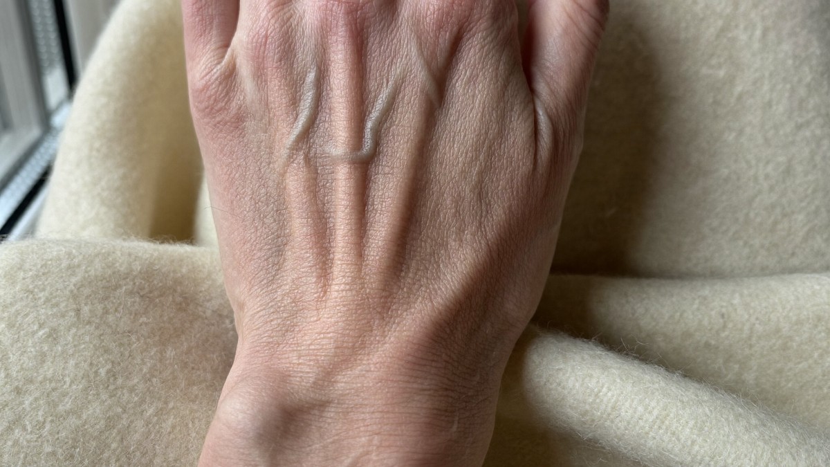 How long does dry winter skin take to heal in the UK?