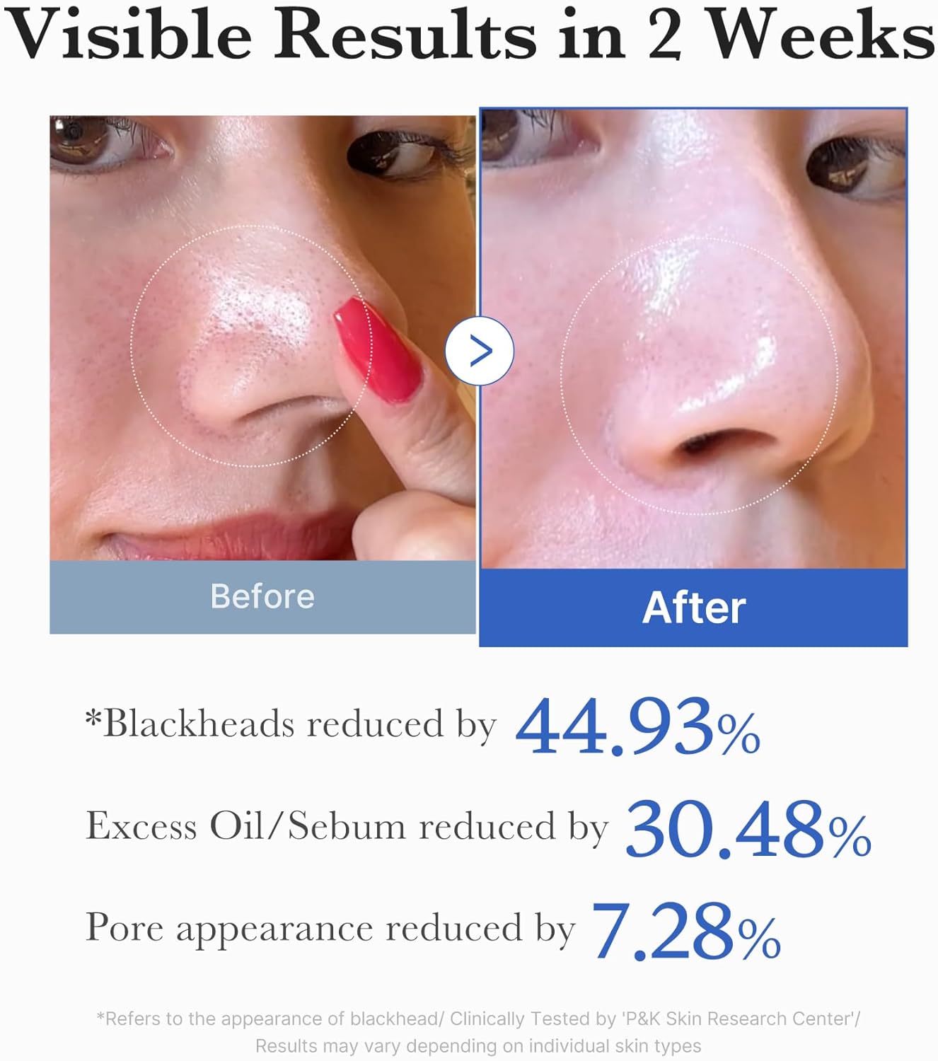 Medicube Zero Pore Pads before and after comparison showing reduced pores and clearer skin with clinical statistics