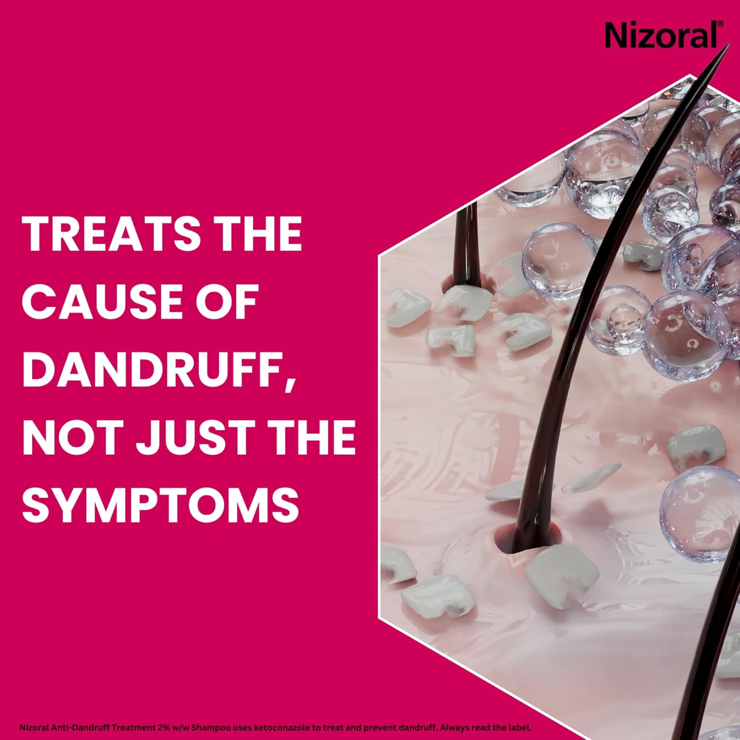Infographic explaining how Nizoral treats the cause of dandruff, not just symptoms