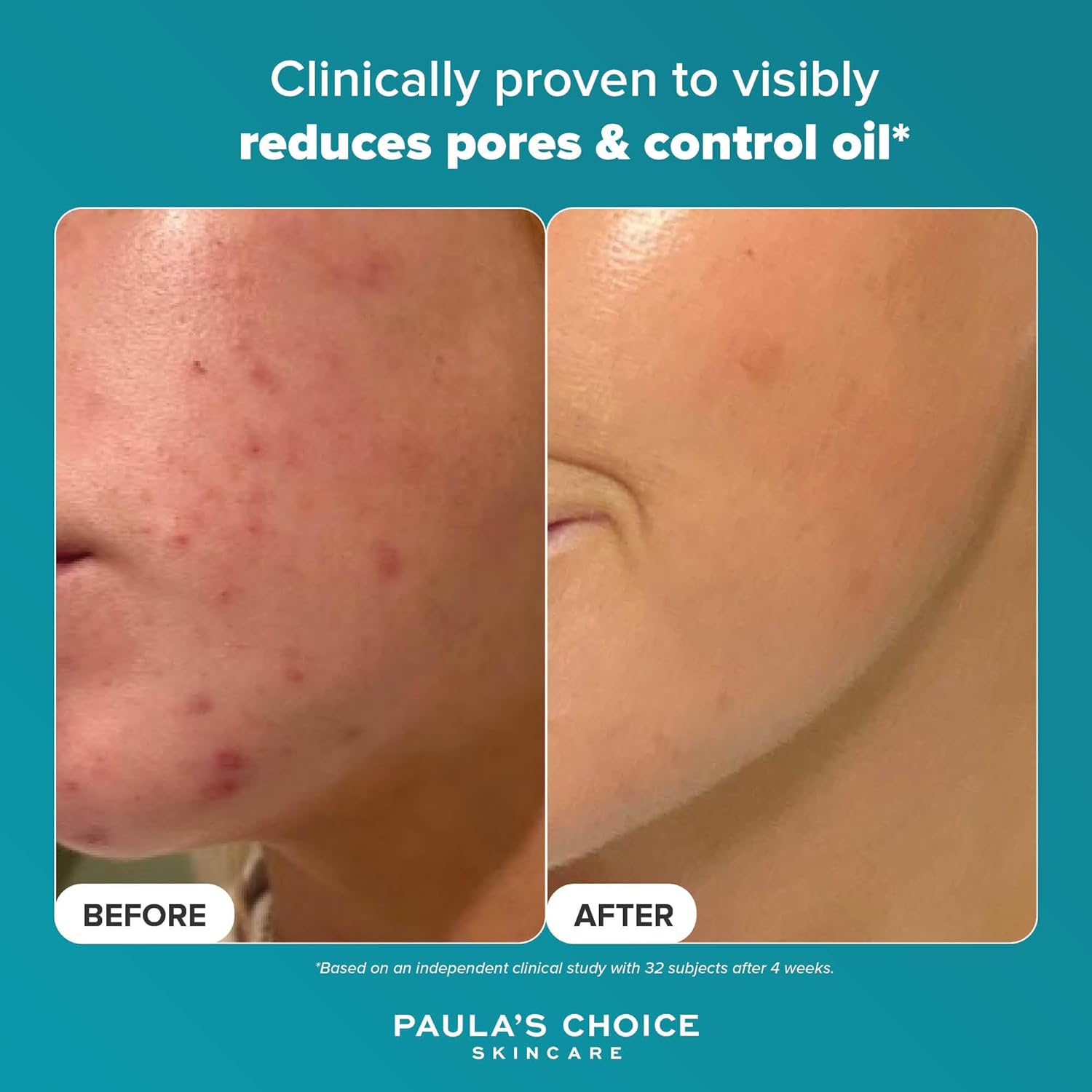 Before and after comparison showing visible pore reduction and improved skin clarity after 4 weeks of using Paula's Choice BHA